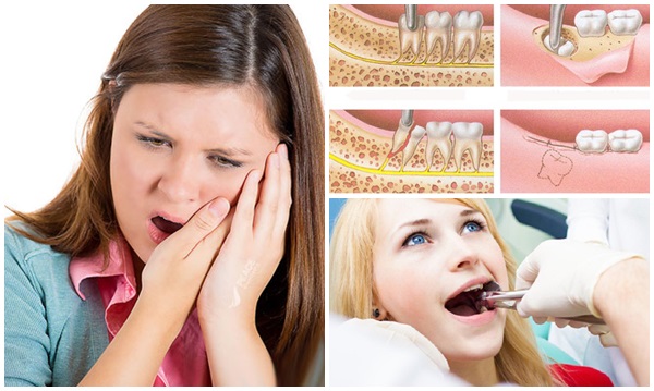 Răng mọc lệch gặp bệnh lý không thể chữa trị, phục hồi
