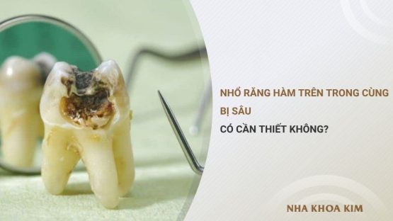 Nhổ răng hàm trên trong cùng bị sâu có cần thiết không?
