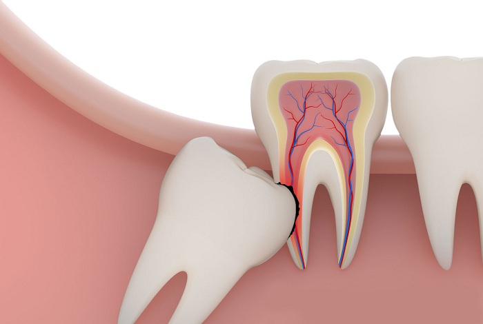 Những yếu tố ảnh hưởng tới chi phí nhổ răng khôn