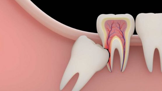 Nhổ răng số 8 – Có nên nhổ bỏ hay giữ lại, vì sao?