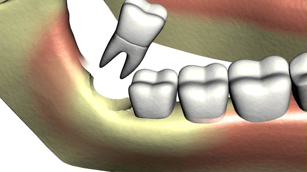 Nhổ răng khôn chỉ là một dịch vụ tiểu phẫu đơn giản
