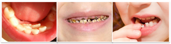 trường hợp nên nhổ răng sữa cho trẻ