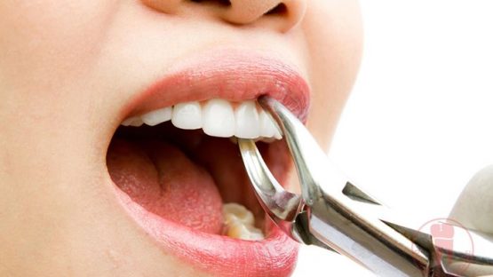Nhổ răng cửa – Không thực hiện khi chưa có chỉ định