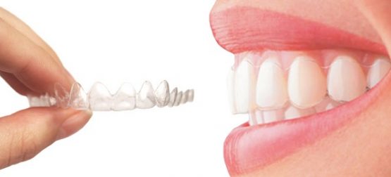 Các bước trong quy trình niềng răng Invisalign