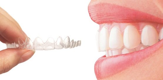 Niềng răng nhựa trong suốt Invisalign – Công nghệ MỚI NHẤT