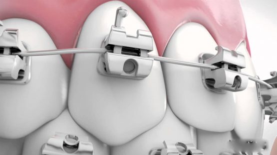 Niềng răng mắc cài tự buộc – Giải pháp chỉnh nha hiệu quả