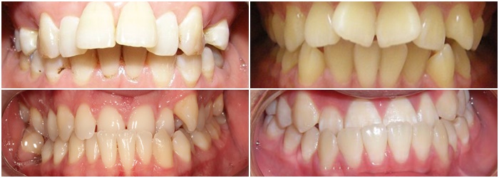 Chỉnh răng hô, móm, lệch lạc bằng phương pháp niềng răng thẩm mỹ 1