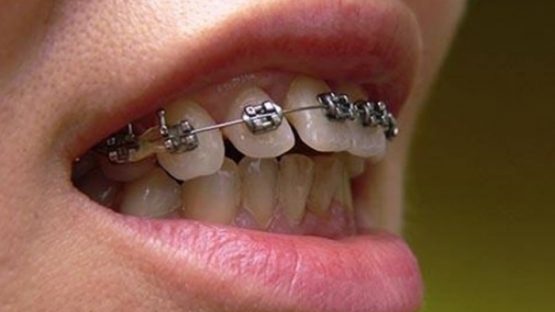 Niềng răng mắc cài Inox – Tất tần tật những thông tin cần biết