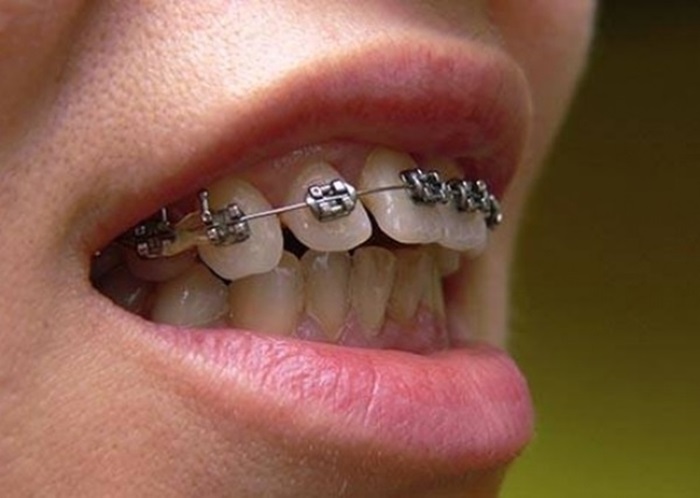 Niềng răng một hàm có thể thực hiện được, tuy nhiên đa số các trường hợp cần được niềng răng hai hàm để đảm bảo tính thẩm mỹ - Nha Khoa KIM
