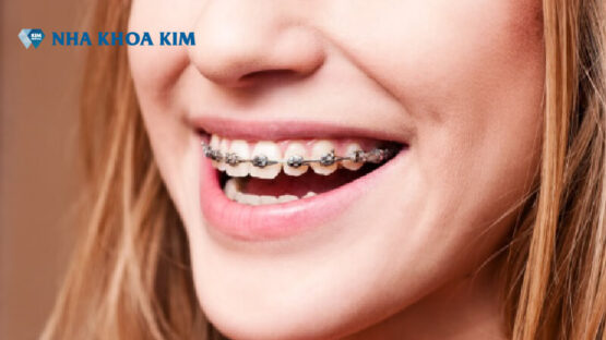 Niềng răng xong có đẹp hơn không? Nha khoa KIM niềng răng đẹp uy tín