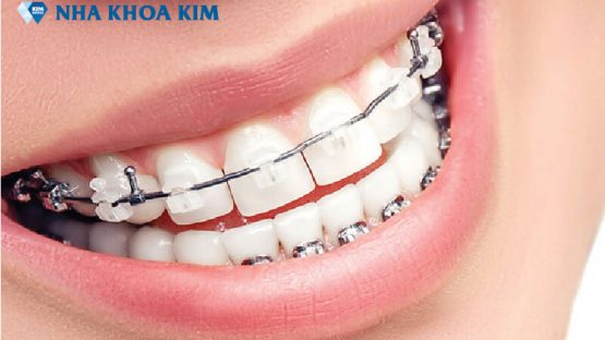 Dịch vụ niềng răng 20 triệu uy tín, chất lượng tại Nha khoa Kim