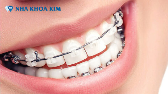 Dịch vụ niềng răng 20 triệu uy tín, chất lượng tại Nha Khoa Kim
