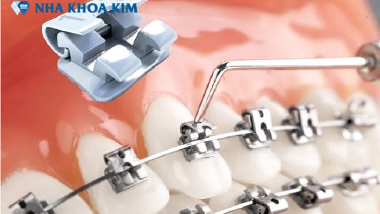 Dịch vụ nắn chỉnh răng ở Hà Nội uy tín, giá tốt, chất lượng