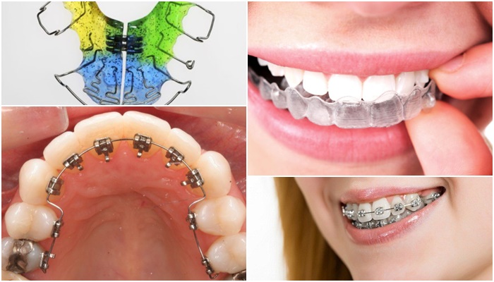 Chỉnh răng hô, móm, lệch lạc bằng phương pháp niềng răng thẩm mỹ 2