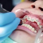 Niềng răng móm bao nhiêu tiền? Làm sao để tiết kiệm chi phí? Niềng răng móm bao nhiêu tiền? Làm sao để tiết kiệm chi phí?