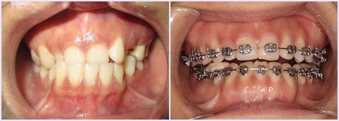 Bọc răng sứ có hết móm không, hay phải điều trị cách nào hiệu quả? 3