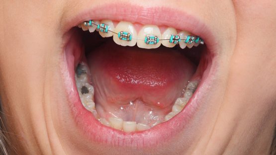 Niềng răng mắc cài kim loại – Tiết kiệm, hiệu quả cao