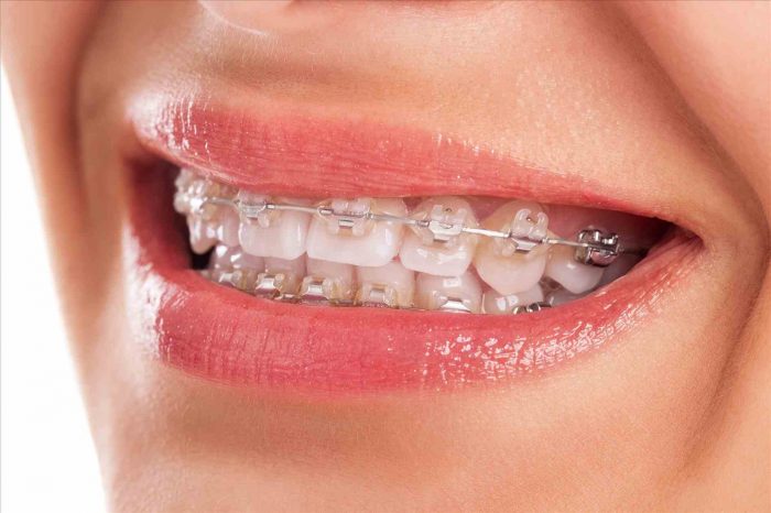 Niềng hàm răng quặp mang lại cho bạn nụ cười tự tin hơn