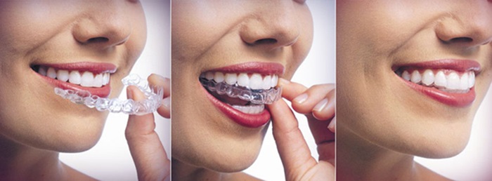 Niềng răng 3D Clear giá bao nhiên tiền? Mức giá chuẩn điều trị? 4