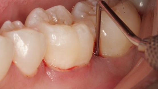 Diệt tủy răng – Vì sao cần thực hiện khi răng bị viêm tủy?