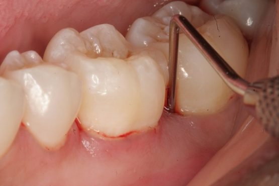 Phải làm gì khi răng sâu chảy máu?