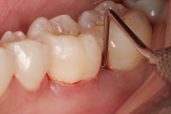 Khi nào cần thăm khám bác sĩ nếu gặp tình trạng răng sâu chảy máu?