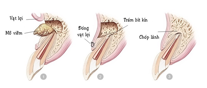 Pháº«u thuáº­t cáº¯t chÃ³p rÄƒng - Cho hÃ m rÄƒng luÃ´n cháº¯c khá»e 1