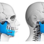 Phẫu thuật chỉnh hàm dưới có hiệu quả thật không? Phẫu thuật chỉnh hàm dưới có hiệu quả thật không?