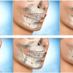 Giá phẫu thuật hàm hô, vẩu bao nhiêu tiền? Giá phẫu thuật hàm hô, vẩu bao nhiêu tiền?