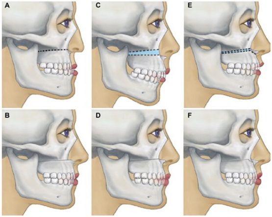 Chỉnh hàm hô bằng phẫu thuật có thực sự đảm bảo an toàn không?