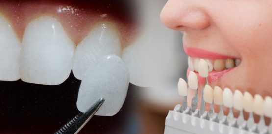 Mặt dán sứ Veneer – Phục hình răng đẹp hoàn hảo, bảo tồn răng thật tối đa