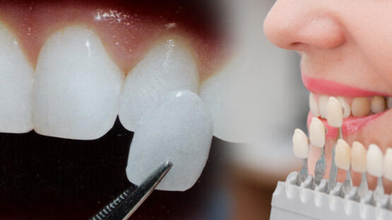 Răng sứ Veneer – Phục hình răng đẹp hoàn hảo, bảo tồn răng thật tối đa
