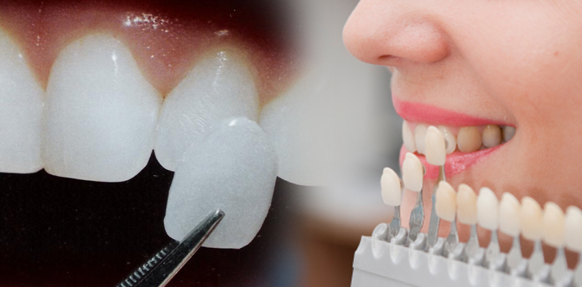 Mặt dán sứ veneer - Phục hình răng đẹp hoàn hảo, bảo tồn răng thật ...