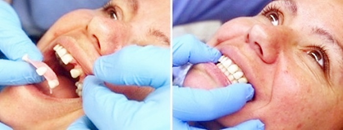 Làm răng giả nhựa - Giải pháp đơn giản giúp khôi phục mất răng 4