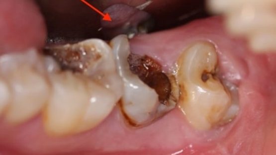 Giá điều trị răng sâu bao nhiêu tiền tại Nha Khoa Kim?