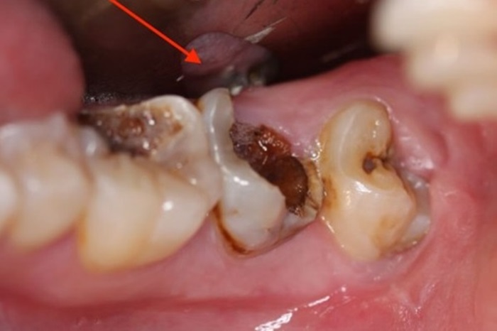 Giá điều trị răng sâu bao nhiêu tiền tại Nha Khoa KIM? 1