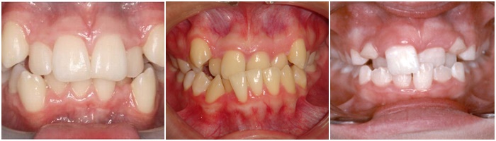 Niềng răng lộn xộn - Công nghệ 3D hiệu quả, thẩm mỹ cao 1