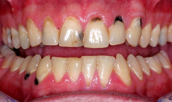 Các nguyên nhân gây sâu chân răng hàm dưới là gì?

