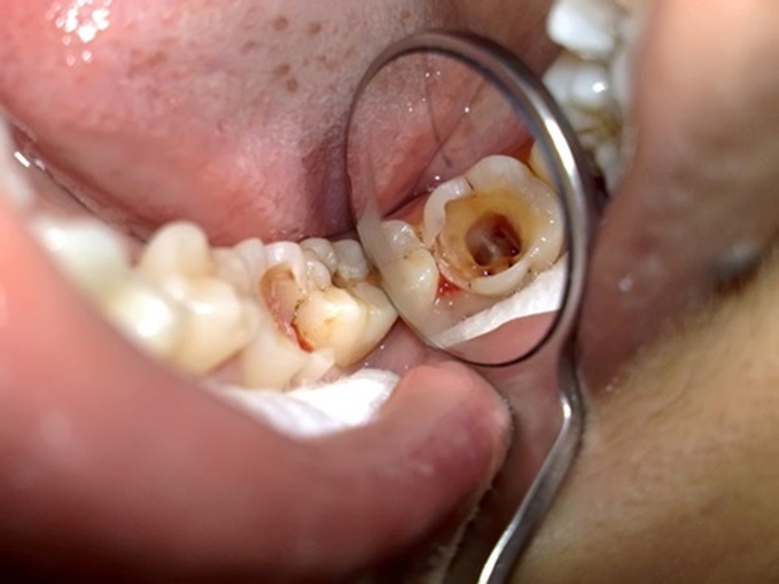 Tác hại của sâu răng đối với sức khỏe răng miệng