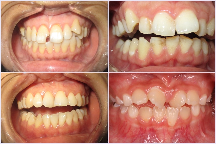 răng sứ cercon - 2