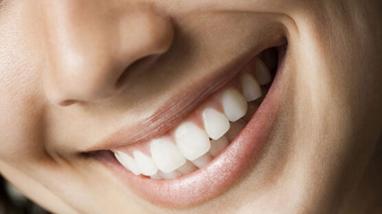 Bọc răng sứ kim loại bị hôi miệng không? Kiến thức quan trọng cần biết