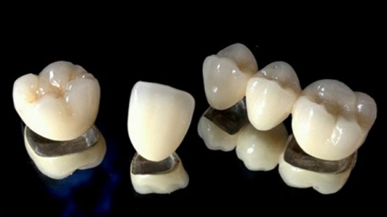 Răng sứ Titan – Mang lại tính thẩm mỹ cao và hiệu quả ăn nhai tốt