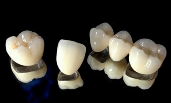 Răng sứ Titan – Mang lại tính thẩm mỹ cao và hiệu quả ăn nhai tốt