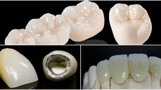 Răng sứ Titan có mấy loại? Dịch vụ bọc răng sứ Titan tại Nha khoa Kim