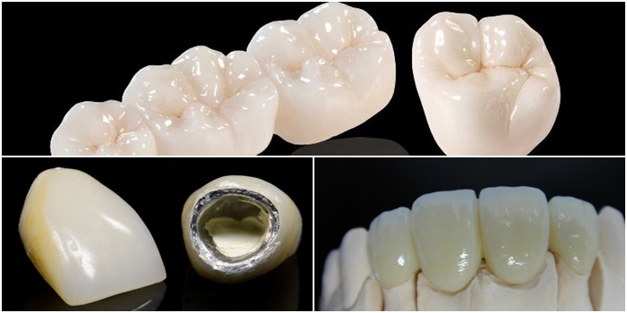 Răng sứ Titan là gì? Cách chăm sóc răng miệng sau khi bọc sứ