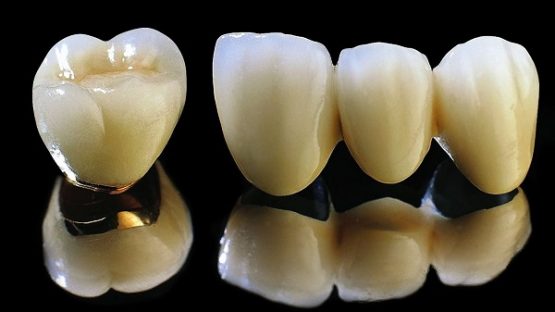 Chất liệu răng giả – Nên chọn phục hình loại nào?