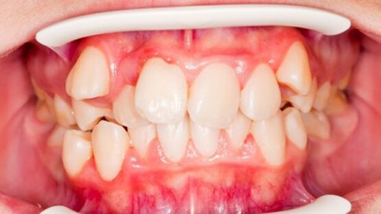 Răng xấu làm sao khắc phục hiệu quả và an toàn nhất?