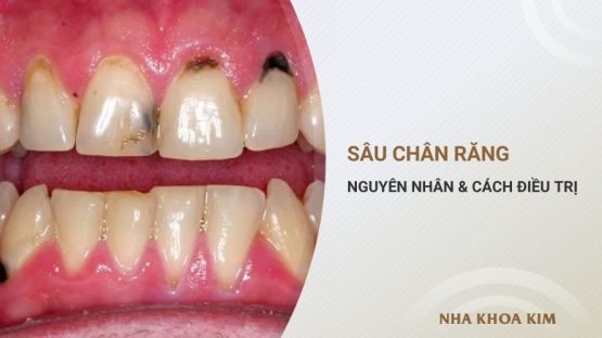 Sâu chân răng – Nguyên nhân là do đâu?