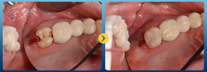 sâu răng hàm dưới - 3