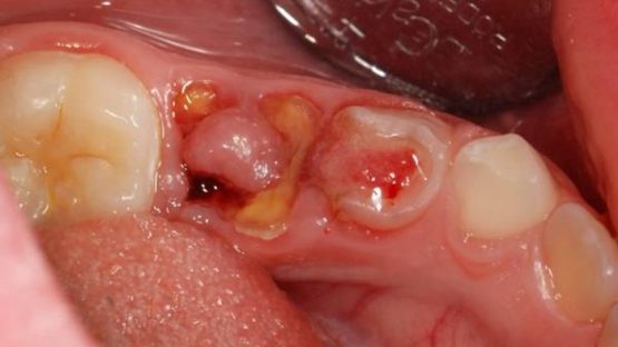 Sâu răng đau nhức phải điều trị thế nào nhanh và hiệu quả?